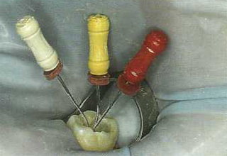 Чистка зубных каналов. Фото 4